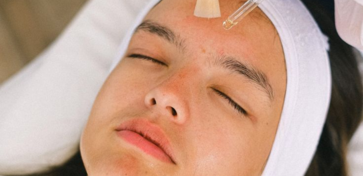 Chemical Peel
