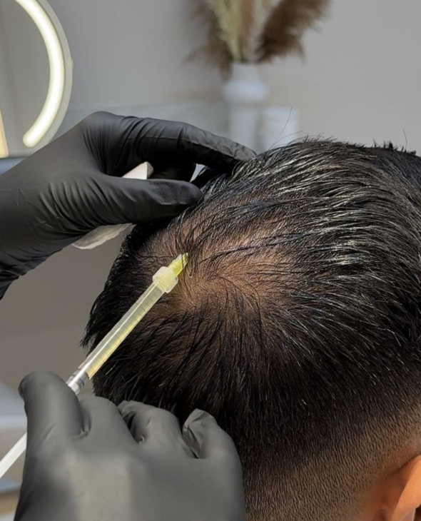 Scalp PRP