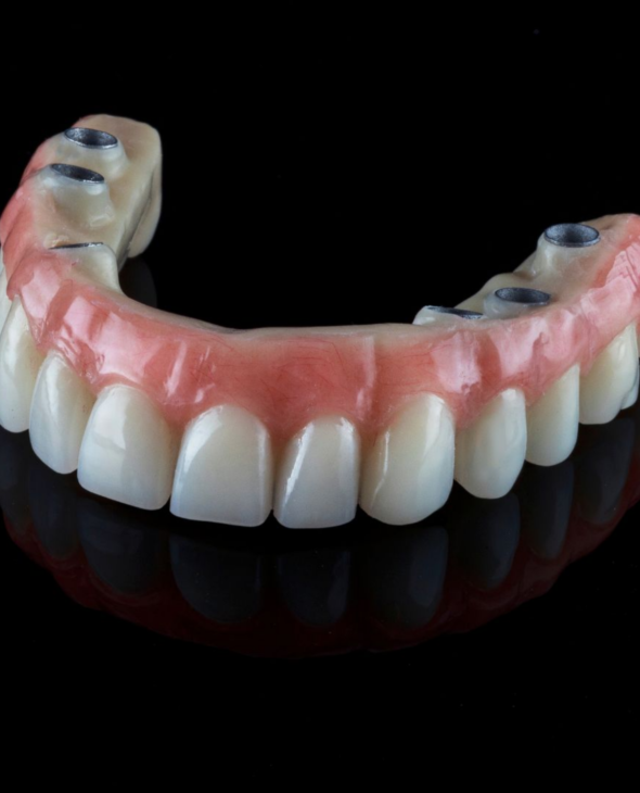 Dental Implants