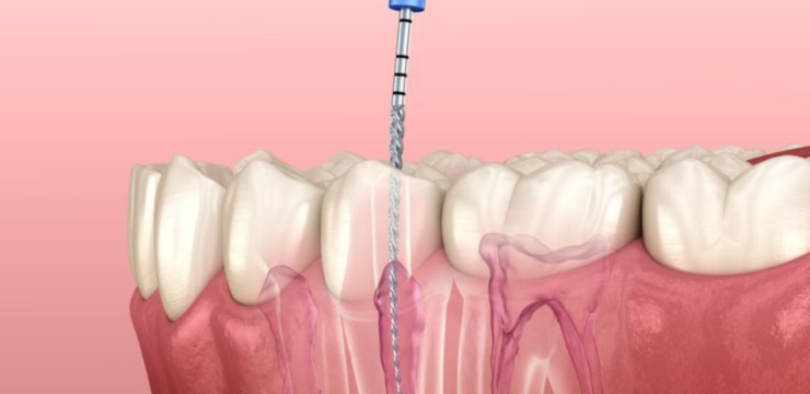 Root canal treatment procedure on tooth