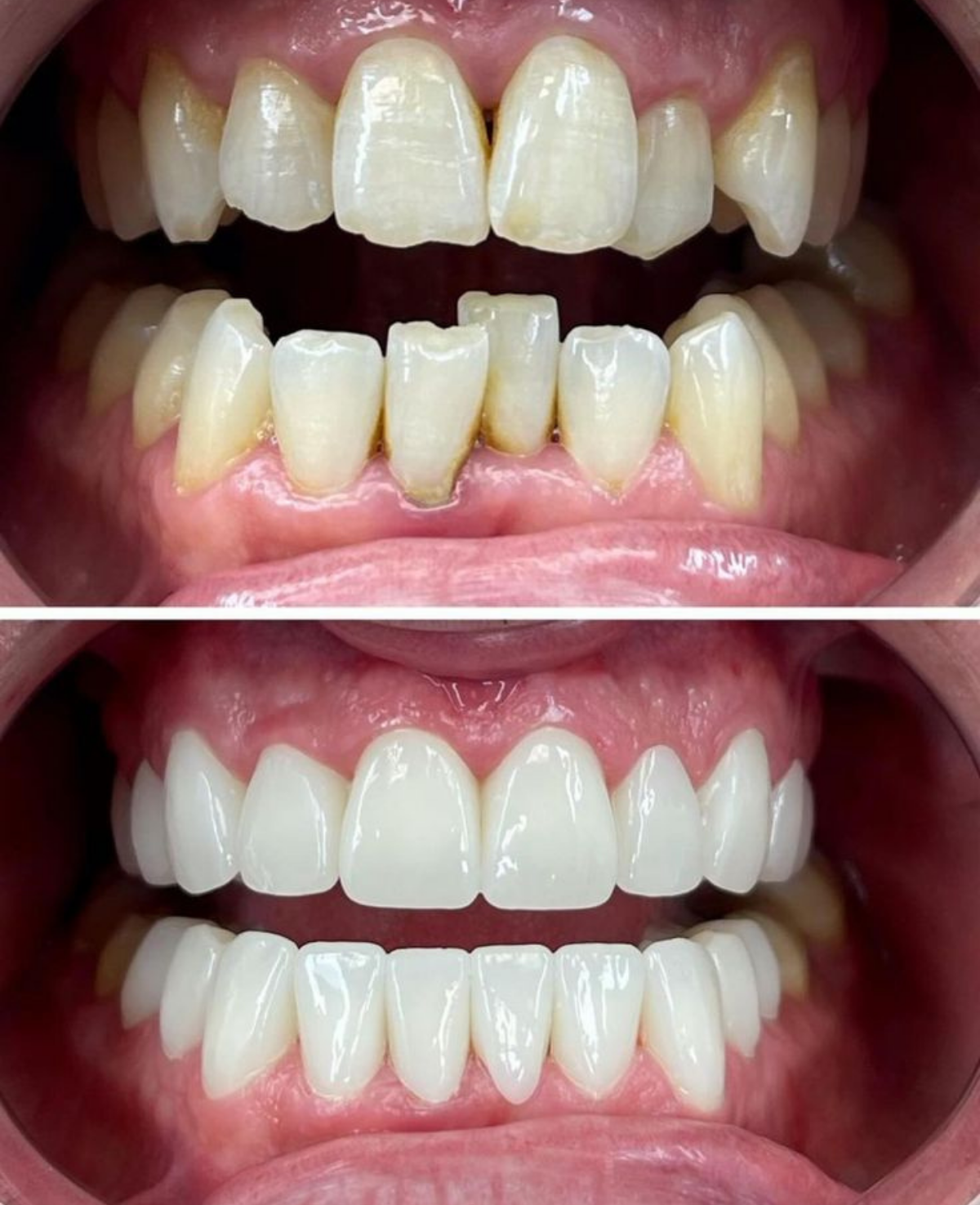 Smile Makeover