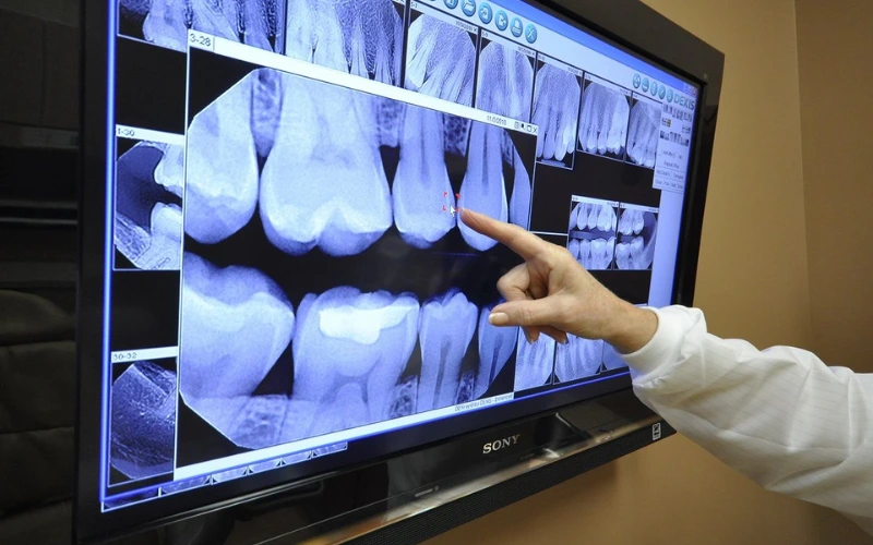 Digital Dental X-Rays