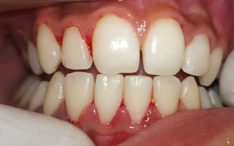 Gum Disease Screening