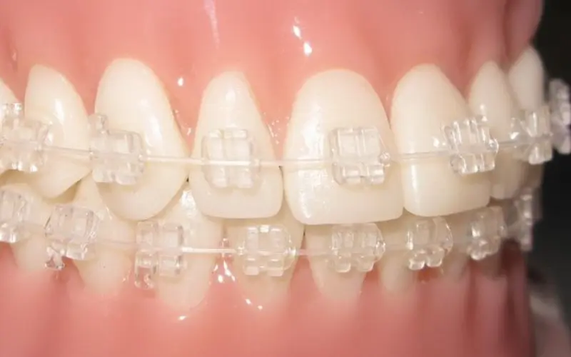 Ceramic Braces