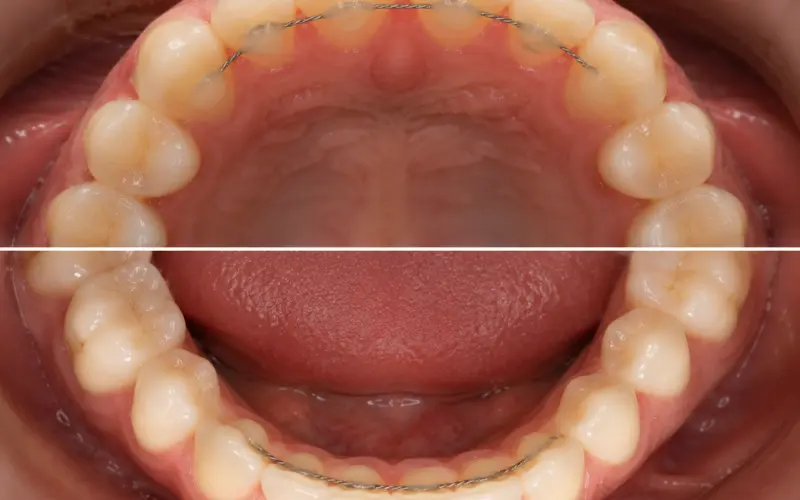 Fixed Retainers