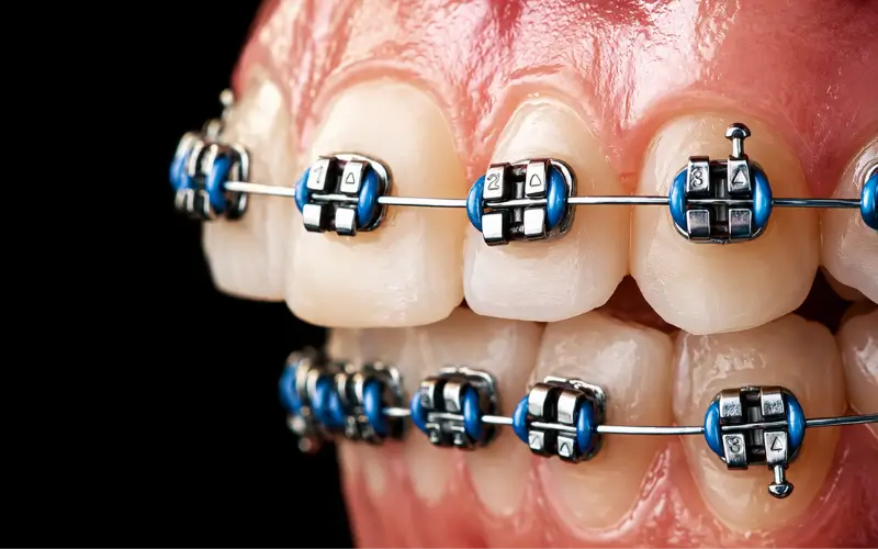 Metal Braces