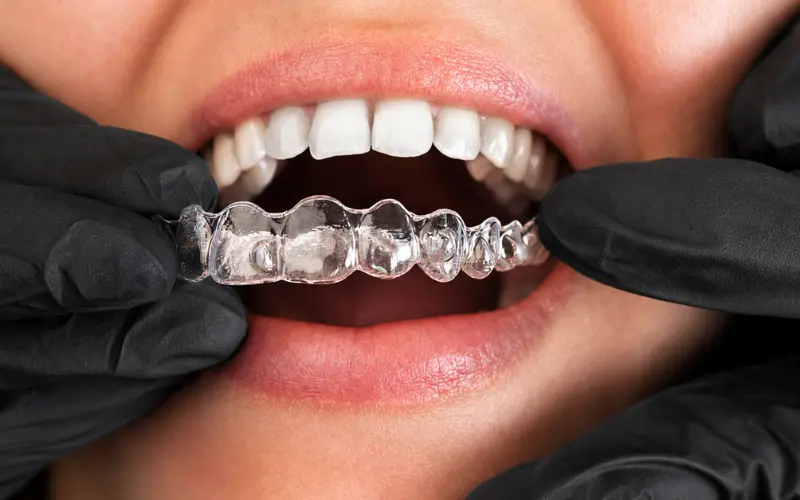 Removable Aligners